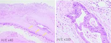 Mcrc is divided into three categories: Colon Cancer Metastasis Mimicking A Hilar Cholangiocarcinoma A Case Report And Literature Review Surgical Case Reports Full Text