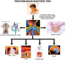 Penyakit tuberkulosis yang merupakan entitas penyakit yang disebabkan bakteri ini telah tercatat. Waspadai Penyakit Tbc Berikut Penyebab Dan Pengobatannya