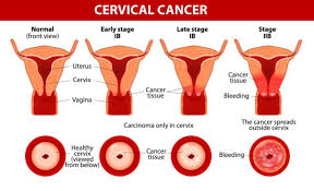 Your doctor or nurse will let you know how often you should be tested. All You Need To Know About Cervical Cancer
