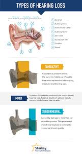 Types Of Hearing Loss Dr Carron Said The Middle Ear Was Perfect So That Means His Isn T Conductive Hearing Health Speech And Hearing Hearing Loss