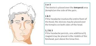 Headaches And Migraine Treatment With Magnetic Therapy Using Q Magnets
