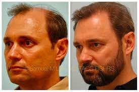 This 50 Year Old Man Is Shown Before And After Hair Transplant Hair Transplant Procedure Hair Transplant Hair Transplant Surgery