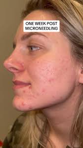 daily microneedling progress. excited to show you the results from my  second session 🤩, #acneskin #microneedling #acnescars #acnescarsremoval  #acnescarring #acnescartreatment #microneedle ...