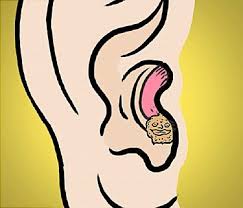 Olive Oil Heat A Little Olive Oil Body Temperature And Put A Few Drops In The Ear Canal Repeat Until The Cap Is Dissolv Ear Candling Ear Wax Candle Ear Wax