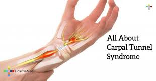 All About Carpal Tunnel Syndrome Positivemed In 2020 Carpal Tunnel Syndrome Carpal Tunnel Syndrome