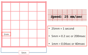 Ecg Basics Rebel Em Emergency Medicine Blog