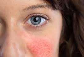 Image result for red rash face