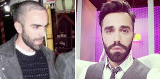 Oğuzhan koç lyrics powered by www.musixmatch.com. Protez Sac Kullanan Unluler Listesi Oncesi Ve Sonra Fotolari Dogru Ve Guncel Hayattan Haberler