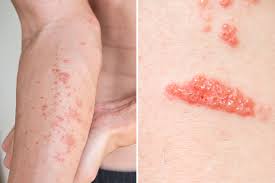 Image result for Atopic eczema atopic dermatitis