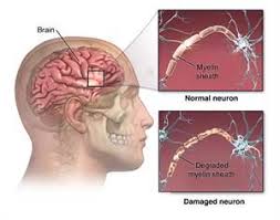 Image result for Multiple Sclerosis