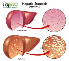 Fatty Liver Diagram Liver Detox Fatty Liver Detox Your Liver