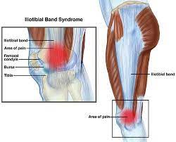 Открыть страницу «itbs information technology business solutions corporation» на facebook. Physical Therapist S Guide To Iliotibial Band Syndrome Itbs Or It Band Syndrome
