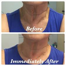 When scheduling your laser hair removal treatments please be sure that you have allowed enough time for all of the artificial tanner to be gone it is dangerous to treat close to the eye with the diode laser. Hendersonville Laser Skincare Home Facebook