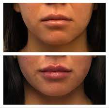 It is a naturally occurring. Lip Injections Dermal Fillers Boss Gal Beauty Bar Columbus Oh