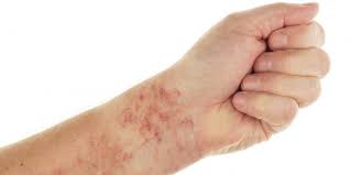 Signs and symptoms of thrombocytopenia can include Homo Medicus On Twitter Trombocitopenia Congenita Trombocitopenia Amegacariocitica Sx De Trombocitopenia Radioausente Sx De Wiskott Aldrich Anemia De Fanconi Y Disqueratosis Congenita Adquiridas Anemia Aplasica Sindrome Mielodisplasico Y