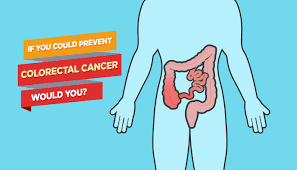 The american cancer society provides helpful information and resources on colorectal cancer. If You Could Prevent Colorectal Cancer Would You Unitypoint Clinic