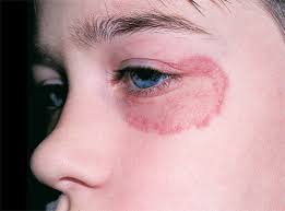 عفونت کرم حلقه ای