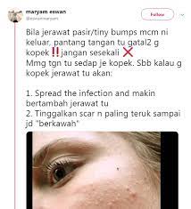 Kemunculan jerawat pasir di area wajah bisa bikin kamu jadi tidak percaya diri. Gadis Ini Dedah Cara Hilangkan Jerawat Dengan Cepat Perkongsian Youtuber Korea Popular Liah Soo Hijabista