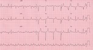 Maybe you would like to learn more about one of these? Atrioventricular Block Concise Medical Knowledge