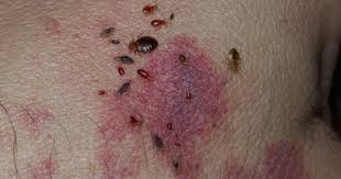 bed bugs disgusting picadura chinche chinches picaduras
