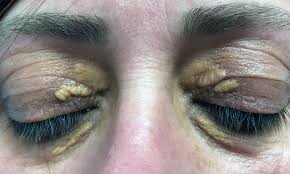 Laser removal by our expert surgeons with minimal scarring. Xanthelasma Causes Treatments Radio Surgery At Dr Jha Clinic By Dr Jha Medium