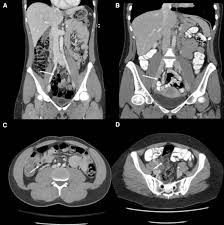 Image result for CT Intravenous Contrast