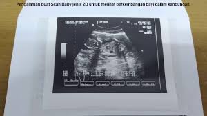 Sebelum membahas lebih jauh terkait harga yang harus dibayarkan setiap kali anda. Scan Baby 2d Di Klinik Swasta Youtube