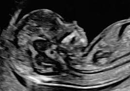 A look at what your scans will involve. Nt Scan Test In Ghatkopar Chembur Kurla Neptune Diagnostics Center