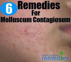 6 Simple And Quick Home Remedies For Molluscum Contagiosum Home Remedies Remedies Health Facts