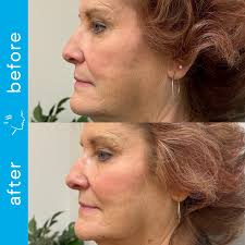 Meet Katie Winner, RN