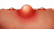Fungal Folliculitis
