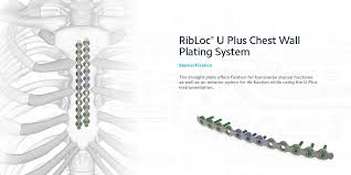 Image result for Sternal Fracture