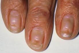 The condition was named by a french physician, joseph honore simon beau, who first described it in 1846. Nail Problems Nhs