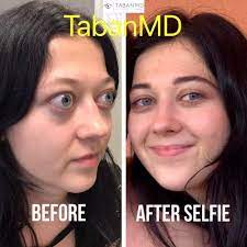 Thyroid eye disease and its healing. Graves Disease Thyroid Eye Disease Orbital Decompression Bulgy Eye Surgery Photos Mehryar Ray Taban Md