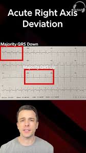 Image result for Right Axis Deviation