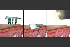 There is no requirement for a request to be in writing, or for the employee to give the employer advance notice. Storing Medical Information Below The Skin S Surface Mit News Massachusetts Institute Of Technology