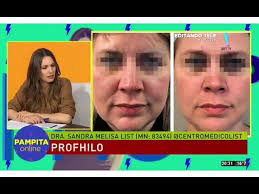La Dra. Sandra List explica Profhilo en Pampita Online