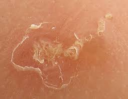 Image result for scabies on humans