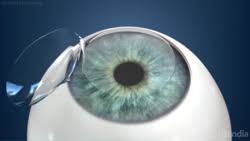 Icl Surgery Costs Side Effects What To Expect Nvision Eye Centers