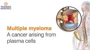 Often, no symptoms are noticed initially. How To Diagnose And Treat Multiple Myeloma