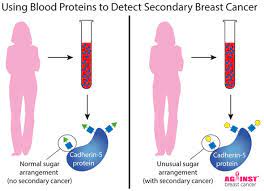 Learn more about laboratory tests and how they are used to diagnose cancer. Blood Test Can Detect Spread Of Breast Cancer Express Co Uk
