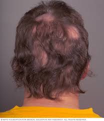 A bald spot in the crown may be a good indication that you are losing hair for genetic reasons but isn't necessarily the case. Hair Loss Symptoms And Causes Mayo Clinic