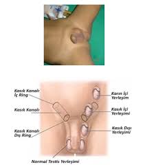 Inmemis Testis Uroloji Uzmani