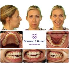 Invisalign Before And After Stories With Our Patients In 2020 Invisalign After Story Healthy Smile