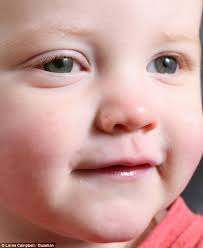 Signs & symptoms of childhood cancer. Toddler Whose Eye Was Glowing Like A Cat S Eye Is Diagnosed With Rare Form Of Cancer Retinoblastoma Daily Mail Online