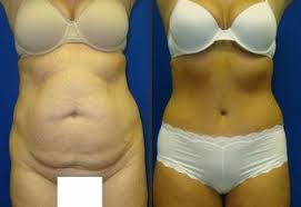 Moreover, the high protein keeps you satisfied for a real long time. How To Get Rid Of Fupa Without Surgery Change Comin