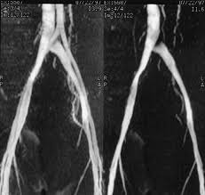 May Thurner Syndrome In An Adolescent Persistence Despite Operative Management Journal Of Vascular Surgery