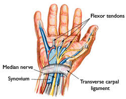 Fela Carpal Tunnel Syndrome Cases Personal Injury Lawyer