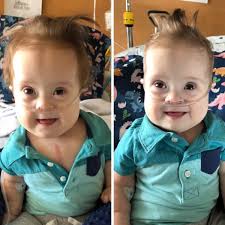 Earlier this summer, Daniela became the 50th patient treated by our  pediatric neuromuscular team with gene therapy! During pregnancy, Daniela's  parents discovered they were both carriers of spinal muscular atrophy  (SMA), a