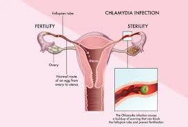 Image result for chlamydia symptoms